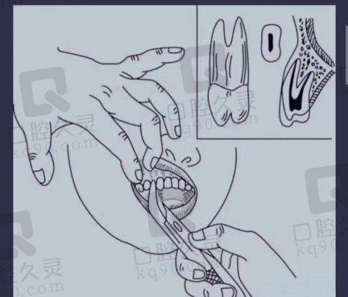 三、不同地区拔牙费用差异
