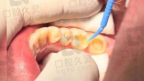 补牙后的成效和感受如何？