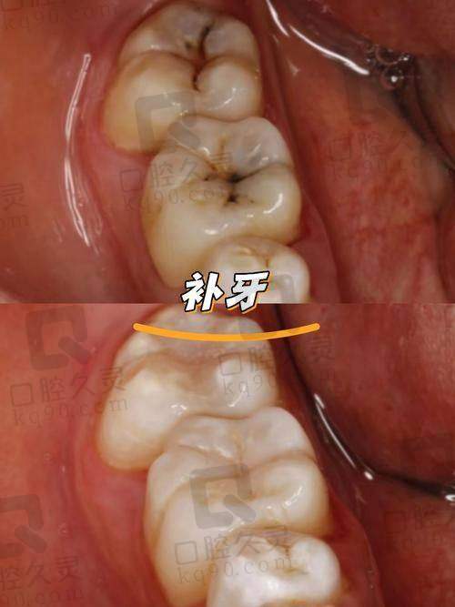 衡水可恩口腔医院做成人P60补牙项目的具体优势
