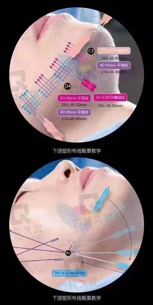 上海华美赵伟医生注射微整、面部年轻化、埋线提升怎么样？