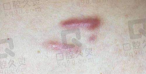 25年深圳鹏程医院疤痕科价格大曝光！注射1800、手术2600起