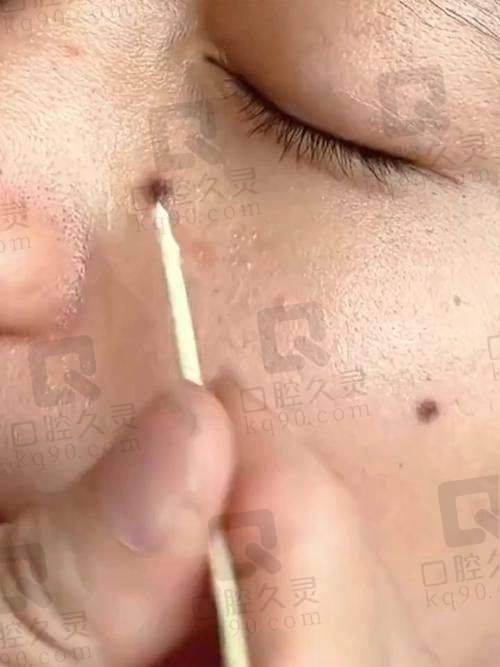 点痣后痂蹭掉了有个大红坑的原因分析