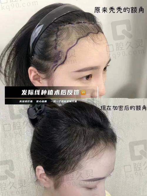 长沙笙泽植发研究院口碑好吗？