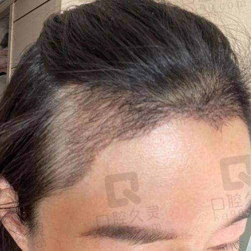 五、天津熙朵植发项目丰富