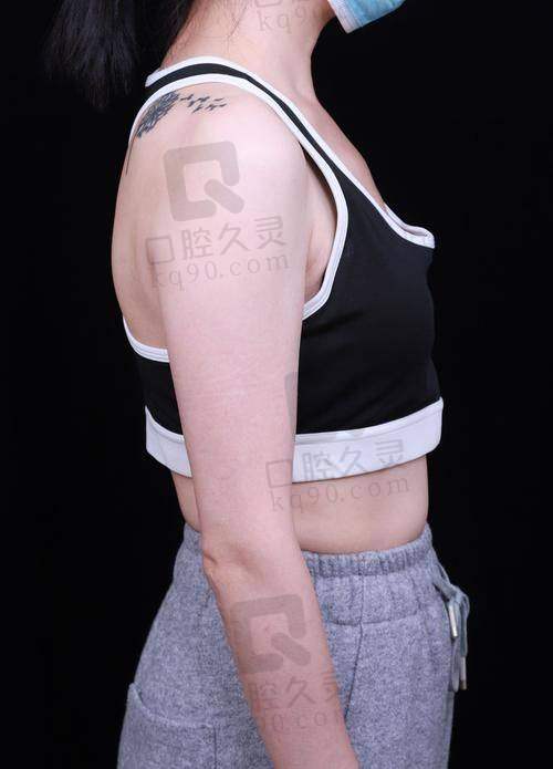 重庆美仑美奂假体隆胸成效怎么样？