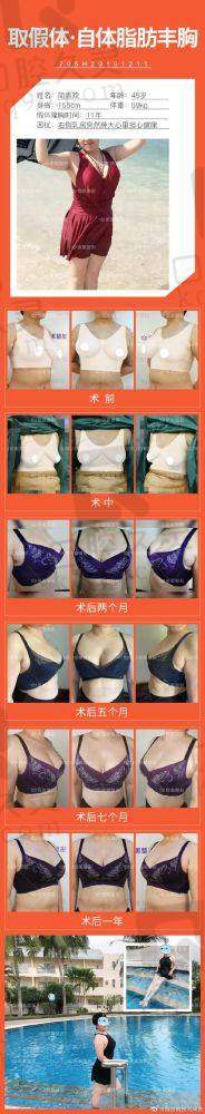 重庆美仑美奂隆胸医生如何？