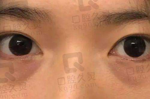 济南艺星刘近兰医生擅长玻尿酸填充技术