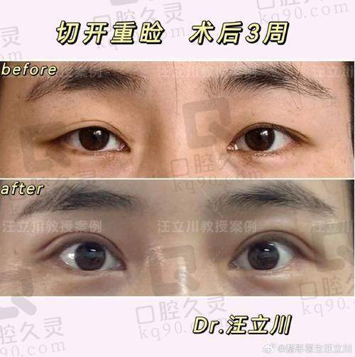 上海艺星李建兵医生做双眼皮修复的技术优势