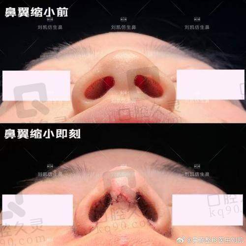 合肥韩美整形外科医院罗安定手术缩鼻翼4359元起，精细操作效果自然，专业团队护航无忧