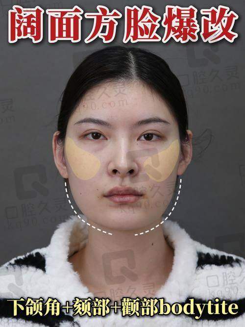 合肥韩美整形外科医院顾浩做下颌角整形项目的具体优势