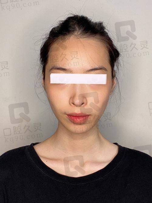 合肥韩美整形外科医院顾浩下颌角整形7789元起，精准塑形、个性设计还保障安全