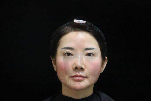 合肥韩美整形外科医院王凤打娇兰玻尿酸丰唇项目价格解析