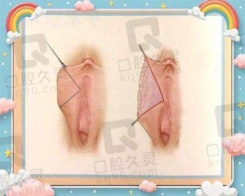 昆明韩辰医疗美容医院薛芝兰菲蜜丽激光紧缩阴道2930元起，安全无痛恢复快，效果显著超安心！