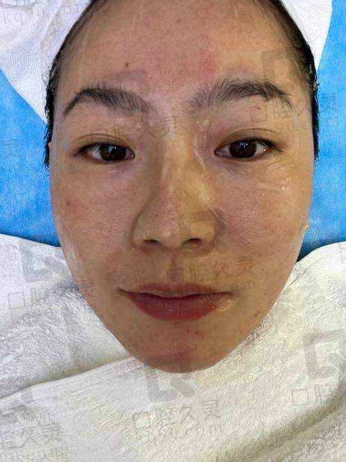 合肥韩美整形外科医院胡准半岛黄金微针801元起，改善肤质、减皱缩孔，技术优服务好！