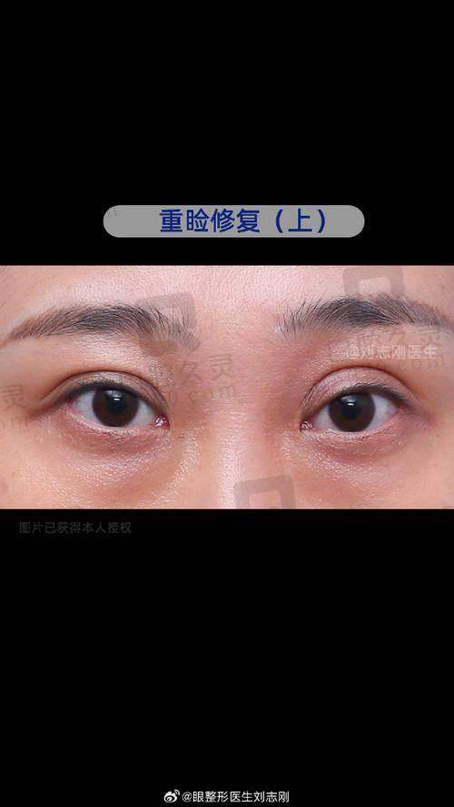上海艺星李建兵做双眼皮修复怎么样，技术口碑及术后恢复效果全解析