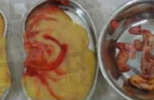 北京煤医周云超擅长什么？异物取出技艺精湛，面部整形、隆胸修复也在行 