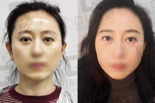 四、李郴华医生双眼皮手术实例成效