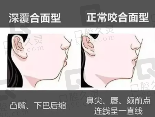 如何选择适合自己的牙齿矫正项目