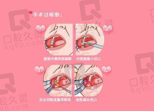 上海时光徐怀河做拉皮手术的口碑