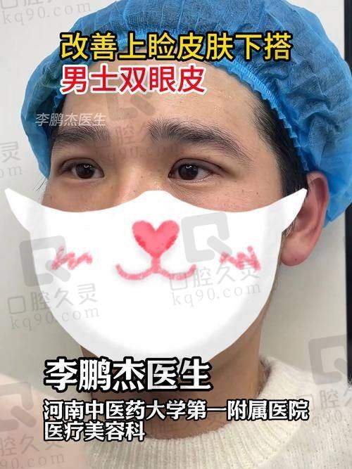 四、余东医生双眼皮修复的情况