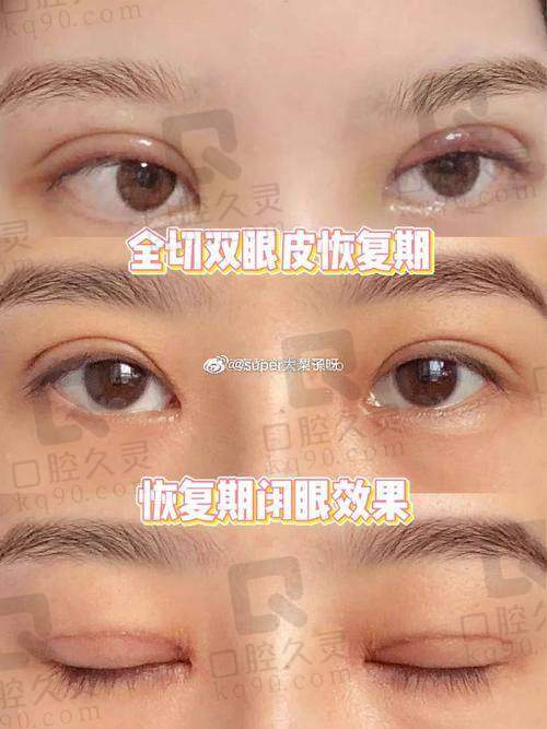 三、李郴华医生双眼皮手术技术优势