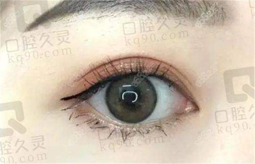 五、深圳阳光医疗美容医院双眼皮手术项目