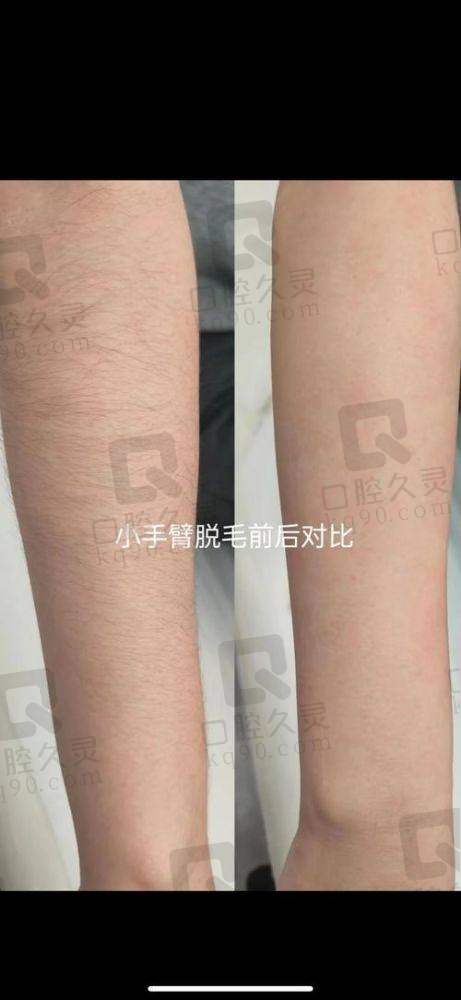 超光子脱毛和冰点脱毛的区别在哪？痛感方面大不同