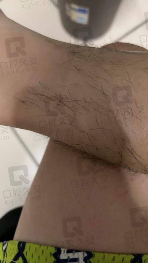 超光子脱毛和冰点脱毛的区别在哪？治疗成效与次数的差别