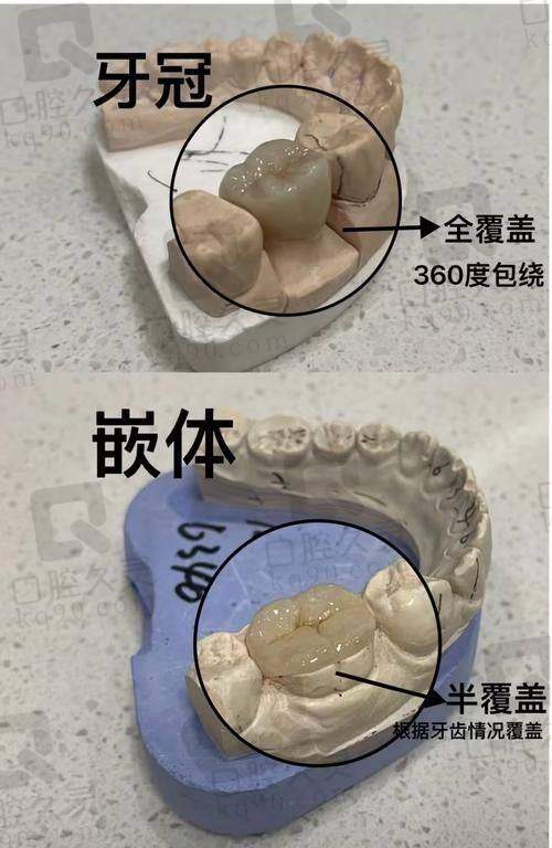 湛江柏乐口腔Emax铸瓷嵌体补牙首颗1180元起，美观适配又健康多项目等你来选
