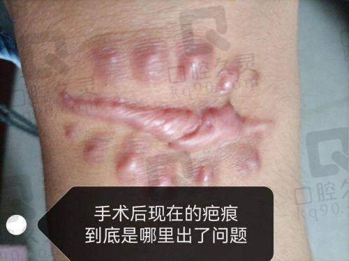 三、患者口碑与实例分享