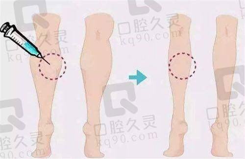 北京腹壁成形术大概多钱？