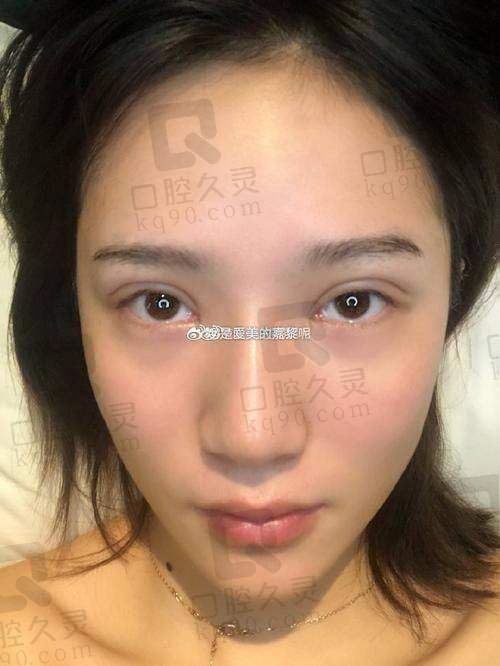 二、北京王博谦医生双眼皮手术技术优势