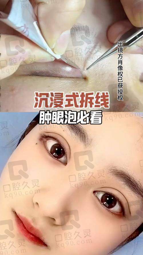 “美杜莎”眼整形技术的特色