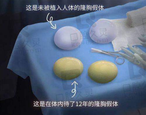 北京曾昂医生做隆胸手术多少钱，含不同假体及手术方式费用一览