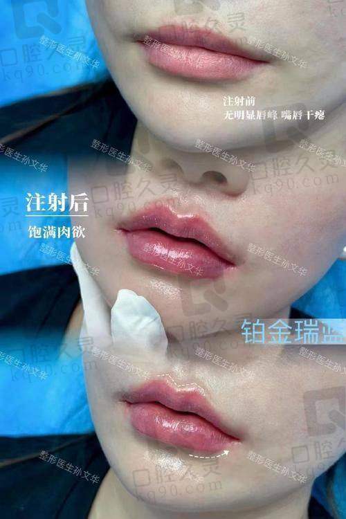 三、法令纹填充脂肪的优缺点