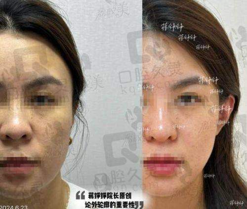 二、法令纹填充脂肪的适应症与谨慎情况