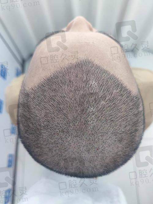 成都大麦和雍禾哪个好？2025成都植发机构对比：大麦微针与雍禾哪个更值得选择？技术、价格与效果全解析！