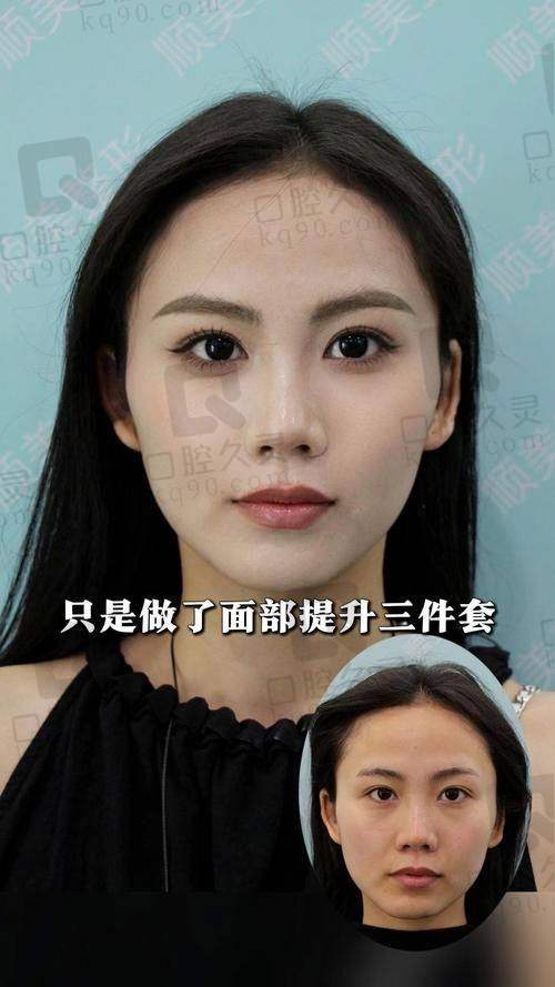李晓东医生的PSV面部提升技术