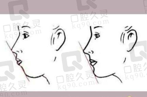 拉皮手术前后对比成效到底有多惊人？
