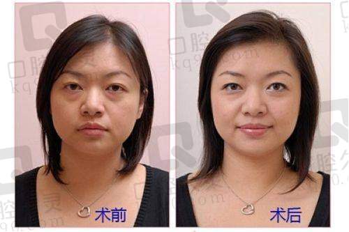 深圳阳光整形美容医院收费价格表之吸脂塑形项目收费合理吗？