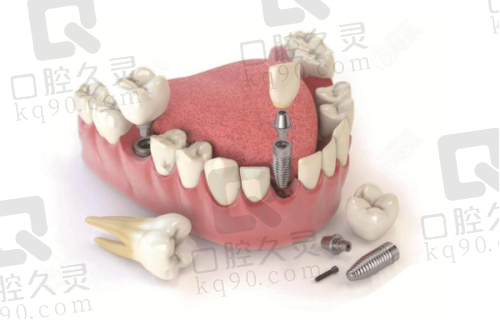 北京爵冠口腔医院种植牙技术怎么样？揭秘其精妙技艺，开启缺牙焕新之旅！ 