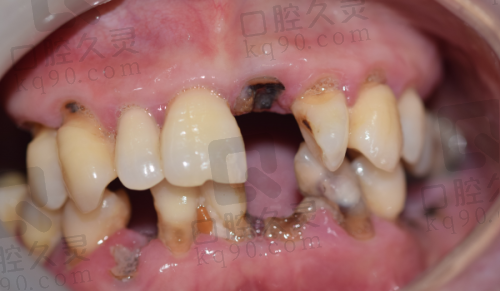 北京爵冠口腔医院种植牙技术的背景与实力