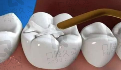 补牙后要装牙套吗？哪些情况可以不装牙套