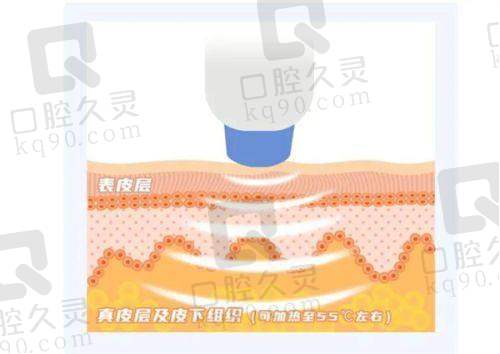 液态热玛吉与提升针的区别