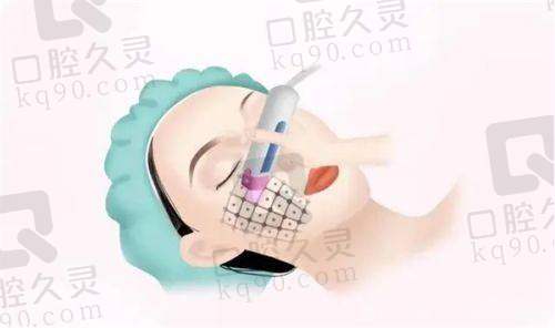 液态热玛吉的定义与原理