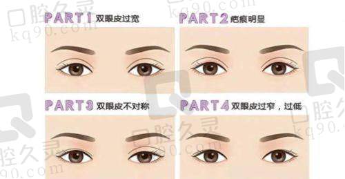 选择济南艺星做双眼皮的优势