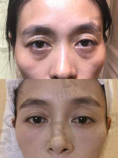 三、上海刘振宇医生祛眼袋的真实实例