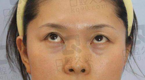 特别多人都在问“上海刘振宇医生祛眼袋怎么样啊”，今天咱们就来详细唠唠。