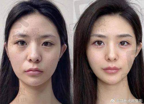 三、如何花好玻尿酸钱