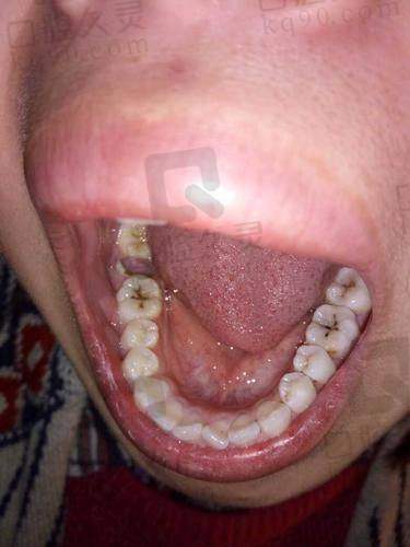 补牙后要装牙套吗？哪些情况建议装牙套
